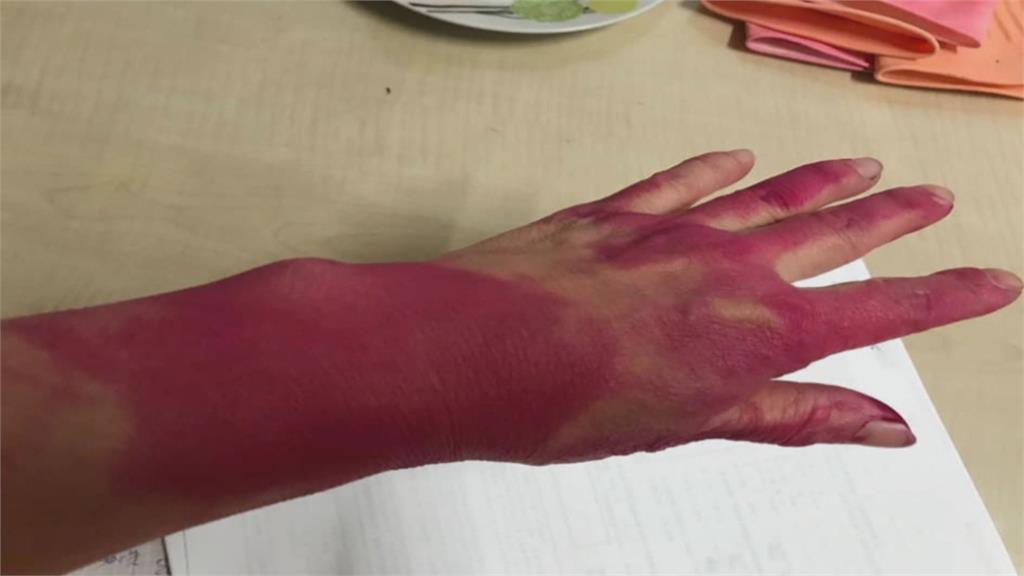 戴乳膠手套大掃除一脫下來整手被染紅....怎麼辦？
