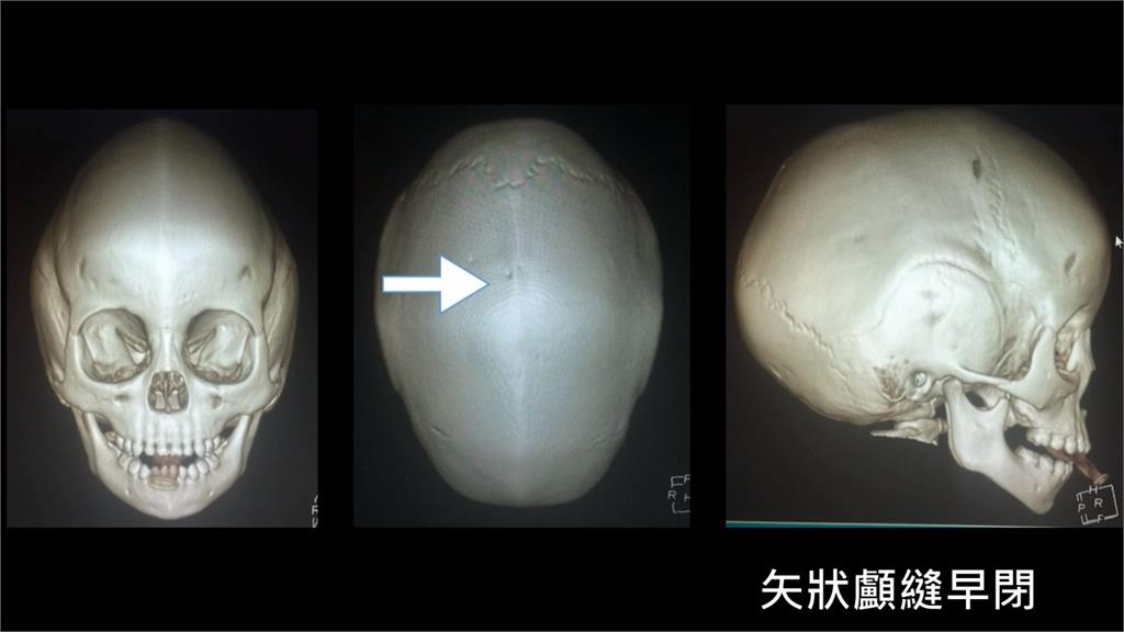 長庚用3d模擬手術 重組頭蓋骨 治癒顱縫早閉症 民視新聞網