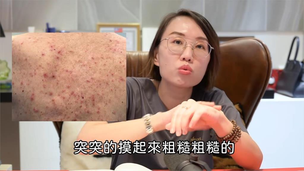 皮膚「起疹紅癢」代表染疫？  醫師：注意手腳末端是否有這症狀！