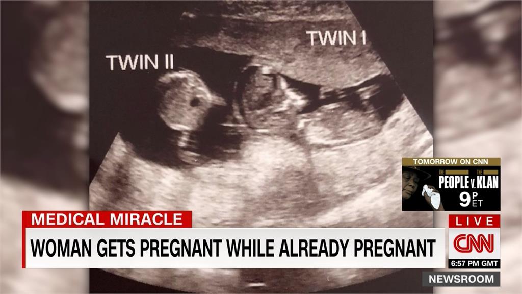 懷孕後三週又懷孕！ 英婦產下「特殊雙胞胎」